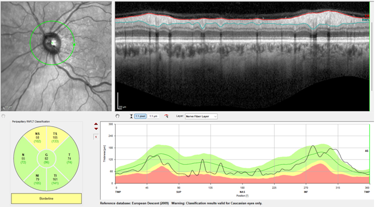Figure 1. Optic nerve topography at initial patient presentation showing mild superior thinning. Patient with hand-motion vision out of the left eye at this visit.
