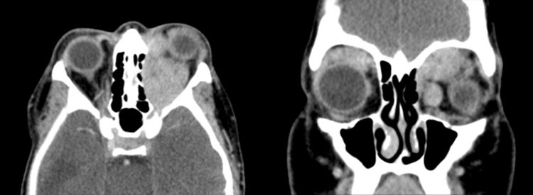 Figure 2. CT orbits with axial and coronal cuts demonstrating bilateral masses, more significant on the left, with marked proptosis and complete encasement of left optic nerve sheath.