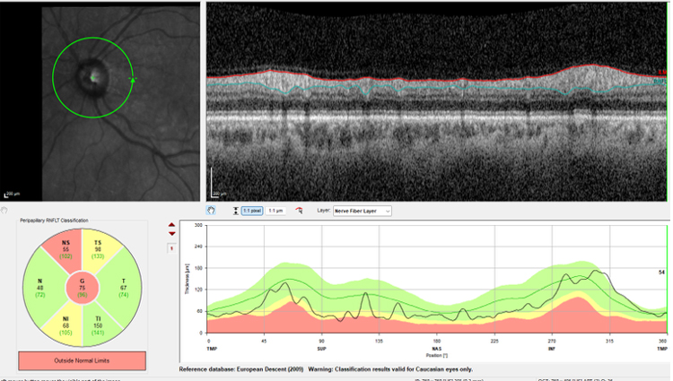 Figure 3. Optic nerve tomography of the left eye showing a significant increase in thinning superiorly, inferiorly, and centrally. At this point in the patient’s care, she no longer had light perception in her left eye.