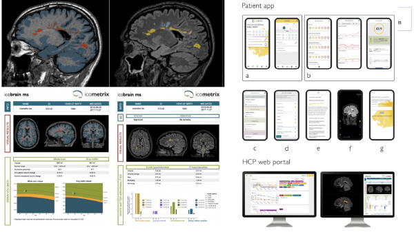 On the left is an example of an Icometrix quantitative MRI report illustrating volumetric brain measures provided to patients with multiple sclerosis. On the right is a screenshot of the icobrain/iCompanion app interface, which allows patients to track symptoms, record clinical data, and share relevant health information with their MS care team between clinic visits.