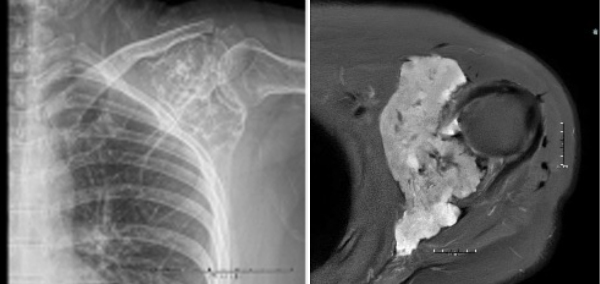 Figure 1: Scapular radiograph and MRI showing evidence of an expansile lesion throughout the upper glenoid extending into the coracoid process.