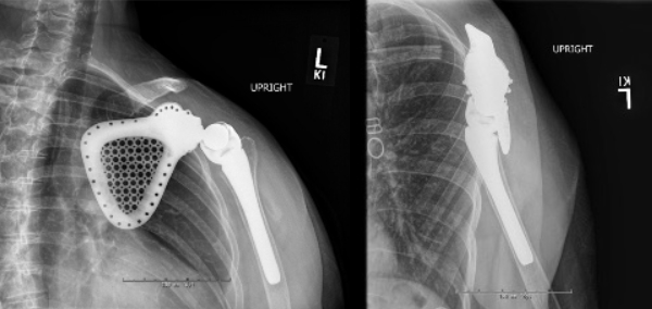 Figure 2: Post-operative radiographs showing left scapular resection with reverse shoulder arthroplasty. 