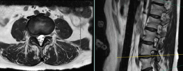 Preoperative MRI showing far lateral and foraminal right L4-5 disc herniation