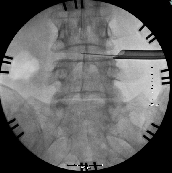 Intraoperative AP fluoroscopy demonstrating targeting through Kambin’s triangle
