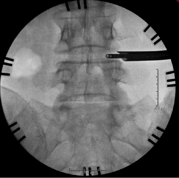 Intraoperative AP fluoroscopy demonstrating removal of the disc fragment with pituitary rongeurs
