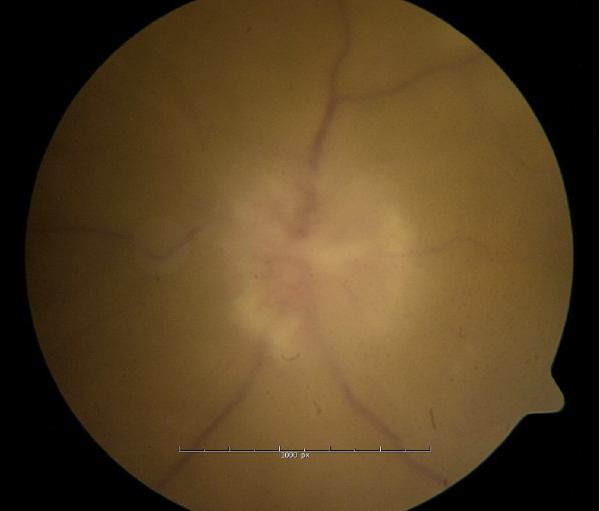Disc photo of the left eye demonstrating significant disc margin obscuration and disc edema.  