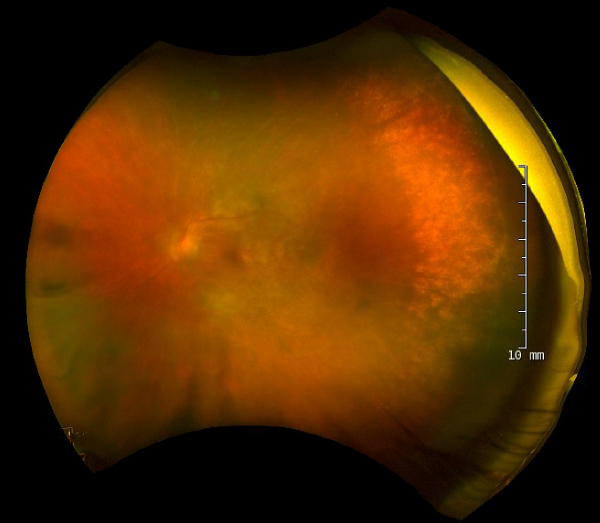 Color fundus photograph of the left eye displaying significant pallid disc edema and vessel obscuration, accompanied by macular infiltrates and patchy perivascular whitening extending to the temporal periphery in the setting of vitreous haze.