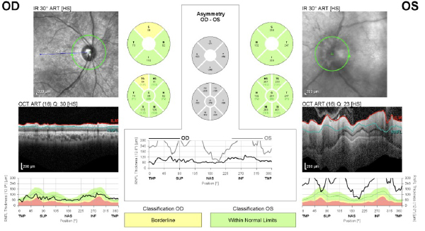 Optical coherence tomography (OCT) of the retinal nerve fiber layer (RNFL) quantified the observed edema, demonstrating a significant asymmetry with an average thickness of 264 µm in the left eye compared to 85 µm in the right eye.