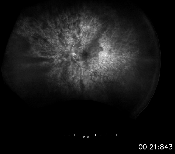 Intravenous fluorescein angiogram of the left eye obtained at 21 seconds (arterial phase) demonstrating patchy choroidal filling. 