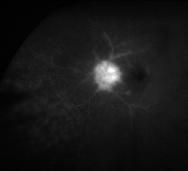 Late-frame fluorescein angiogram obtained at 6 minutes and 47 seconds demonstrating arterial staining, vessel non-perfusion, peripheral leakage, and staining of the optic disc.