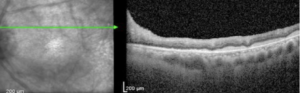 OCT of the left eye reveals infiltrative lesions extending from the optic nerve to the temporal macula on infrared imaging, with B-scans demonstrating vitreous haze, inner retinal architectural disruption with edema, and a prominent hyper-reflective infiltrate occupying the sub-retinal space.