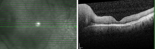 OCT of the left eye reveals infiltrative lesions extending from the optic nerve to the temporal macula on infrared imaging, with B-scans demonstrating vitreous haze, inner retinal architectural disruption with edema, and a prominent hyper-reflective infiltrate occupying the sub-retinal space.