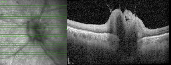 OCT of the left eye reveals infiltrative lesions extending from the optic nerve to the temporal macula on infrared imaging, with B-scans demonstrating vitreous haze, inner retinal architectural disruption with edema, and a prominent hyper-reflective infiltrate occupying the sub-retinal space.