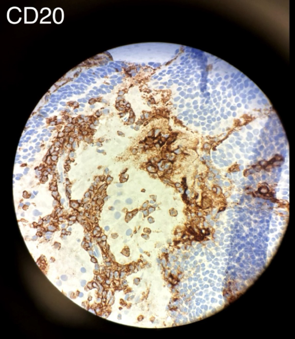 CD20 immunohistochemical staining of the retinal specimen confirming the diagnosis of Diffuse Large B-cell Lymphoma.