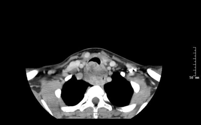 CT scan of the tumor