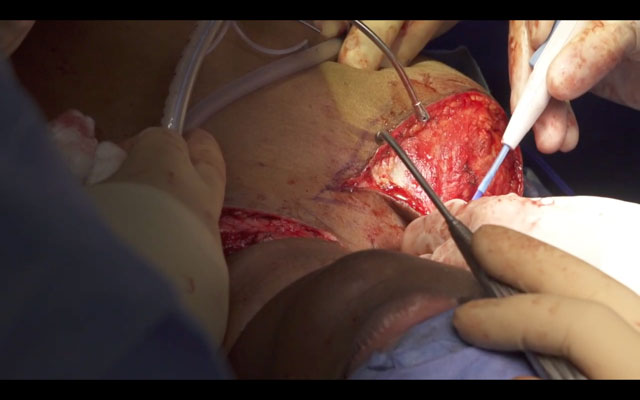 Creation of the supraclavicular pedicled fascial flap