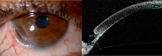 Figure 1: (a) Slit lamp photograph demonstrating an area of significant peripheral corneal thinning extending from 7 to 9 o'clock with adjacent conjunctival injection. (b) Anterior-segment OCT showing 76% thinning of the peripheral cornea with 0.17mm of residual cornea.