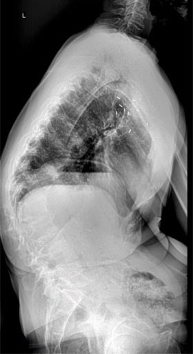 Standing lateral (sideview) X-ray showing the significant kyphosis of the thoracolumbar spine with loss of the patient’s height and compression of her abdomen.