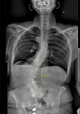 Standing X-ray viewed from the backside showing the 73 degree left sided scoliotic curve. Note the right sided ribs rubbing on the pelvis.