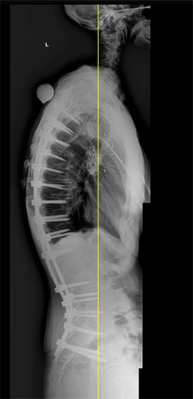 Standing post-operative sagittal X-ray showing the significant correction of the patients upright posture. Note the need of the sacral -pelvic fixation to hold this patient’s position.