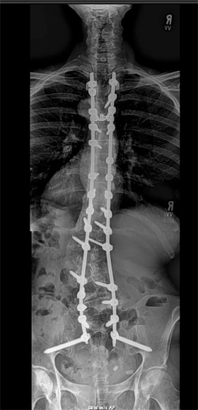 Standing post-operative X-ray showing the spinal fixation and the correction of the scoliosis.