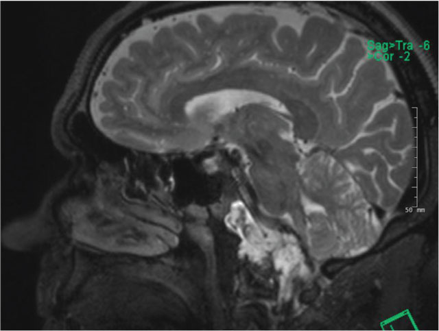 Sagittal T2 MRI demonstrating a hyperintense lesion in the clivus with intradural extension and compression of the brainstem.