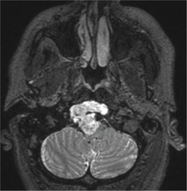 Axial T2 MRI demonstrating hyperintense lesion in the clivus with intradural extension and encouragement of neurovascular structures and displacement of the brainstem.