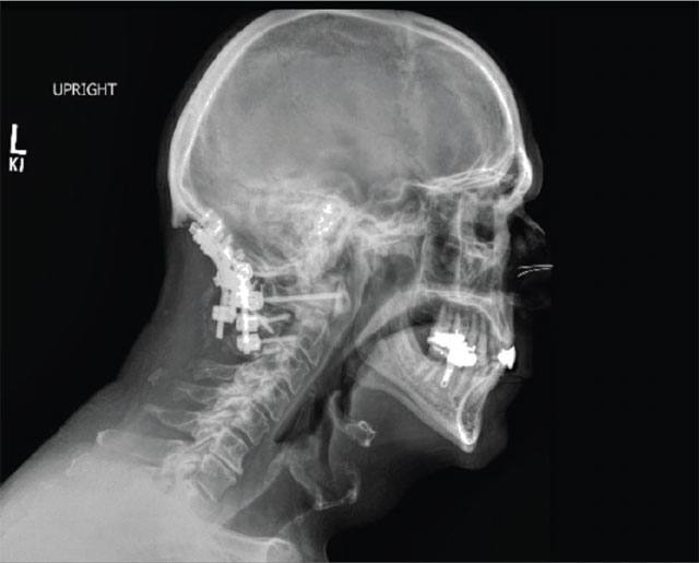 Lateral radiograph showing the spinal reconstruction.