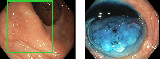 GI identifies and frames adenomas with a green box. The images in blue show what the polyp looks like after a dye is injected during the colonoscopy.