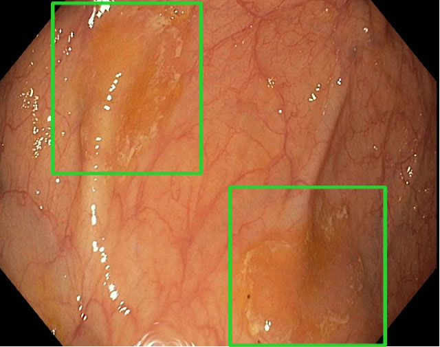 GI identifies and frames adenomas with a green box. The images in blue show what the polyp looks like after a dye is injected during the colonoscopy.