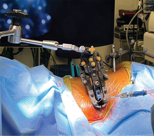 Intraoperative photograph with the MIS lateral retractor in place stabilized by the robotic arm.