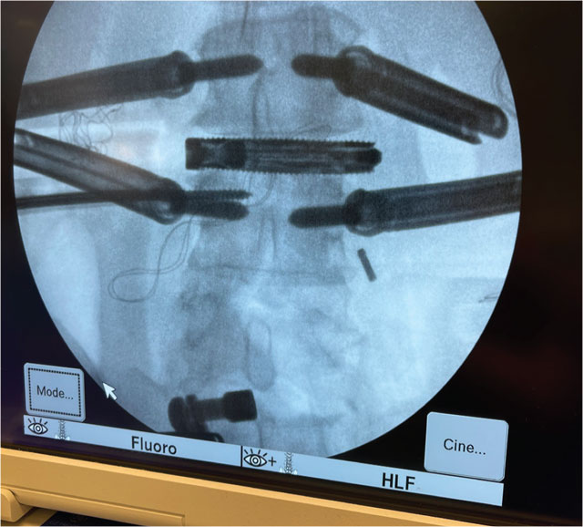Intraoperative AP fluoroscopic image showing the pedicle screws and lateral interbody fusion cage in position.