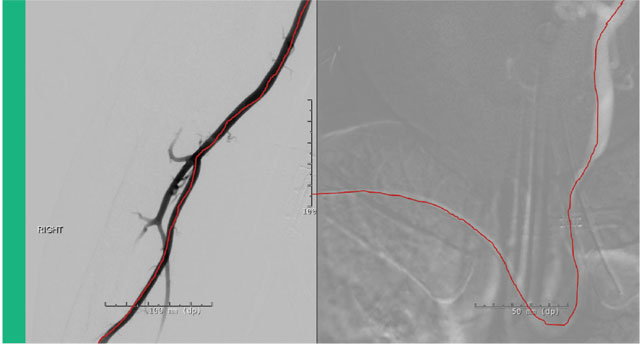 Figure 1: Angiogram of right radial artery of the vascular access route from the wrist towards the left sided intracranial circulation.