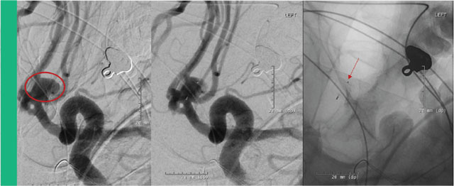 Figure 2. Angiographic images demonstrating the aneurysm of the anterior communicating artery. The red circle demarcates the aneurysm. The arrow is pointing to the distal aspect of the WEB device once deployed within the aneurysm.
