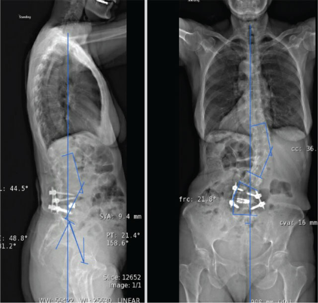 Preoperative AP and lateral radiographs demonstrating adult degenerative spinal deformity.