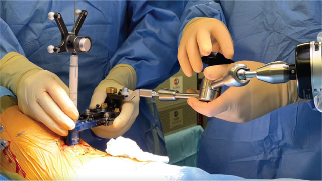 Intraoperative photograph showing the use of the robotic 3D navigation system to dock the minimally invasive retractor system on the spine to perform lateral lumbar fusion and deformity correction.