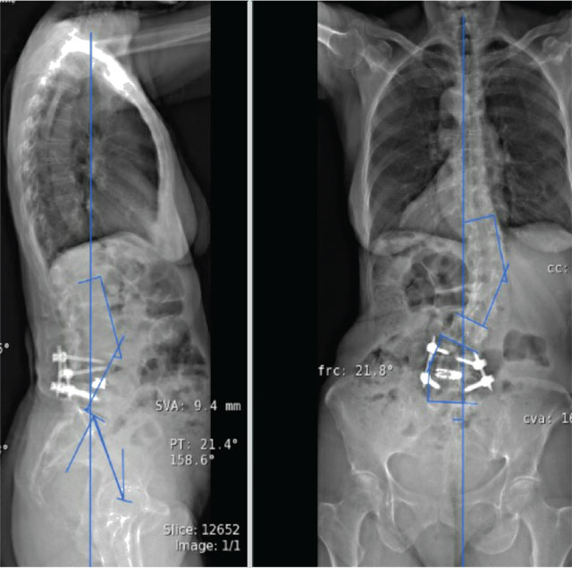 Pre- (left) and post- (right) operative radiographs demonstrating final reconstruction of adult degenerative spinal deformity.