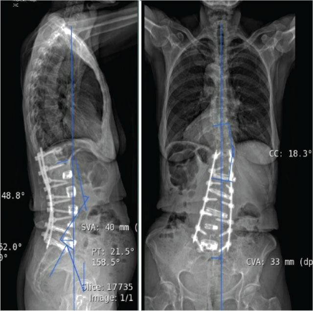 Pre- (left) and post- (right) operative radiographs demonstrating final reconstruction of adult degenerative spinal deformity.