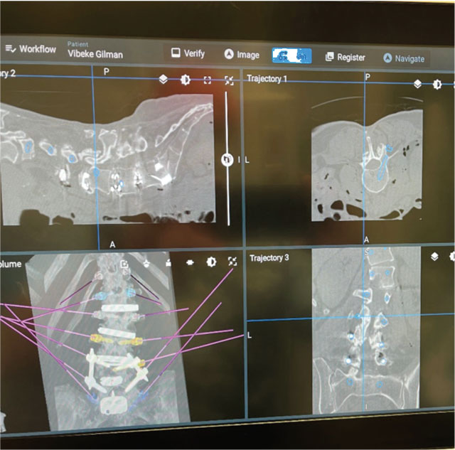 Intraoperative photographs showing the use of the robotic 3D navigation system to plan and place posterior spinal instrumentation for deformity correction.