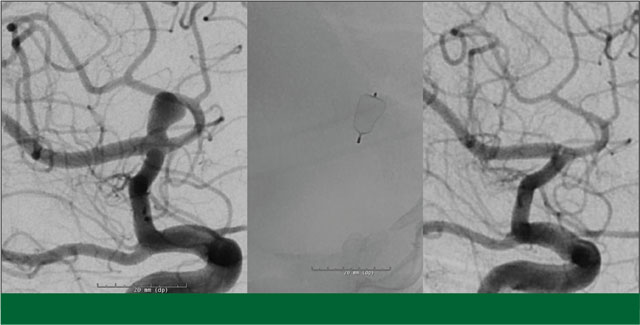 Angiographic images of the aneurysm before, and after at follow-up, with an image showing the WEB device in between.