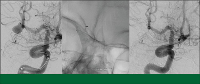 Angiographic images of the aneurysm before, and after at follow-up, with an image showing the WEB device in between.