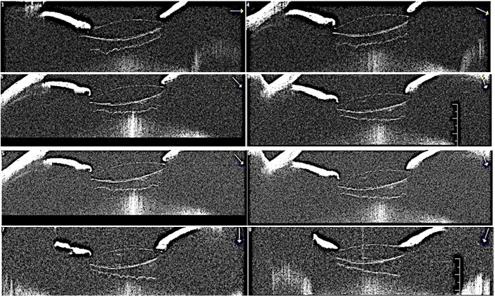 Figure 2 | Anterior segment OCT images