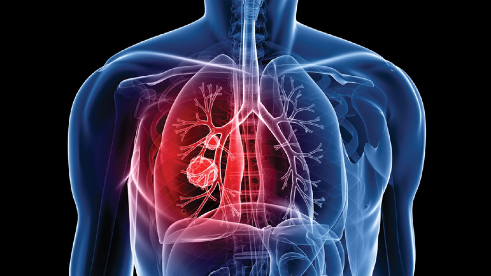 lung cancer 