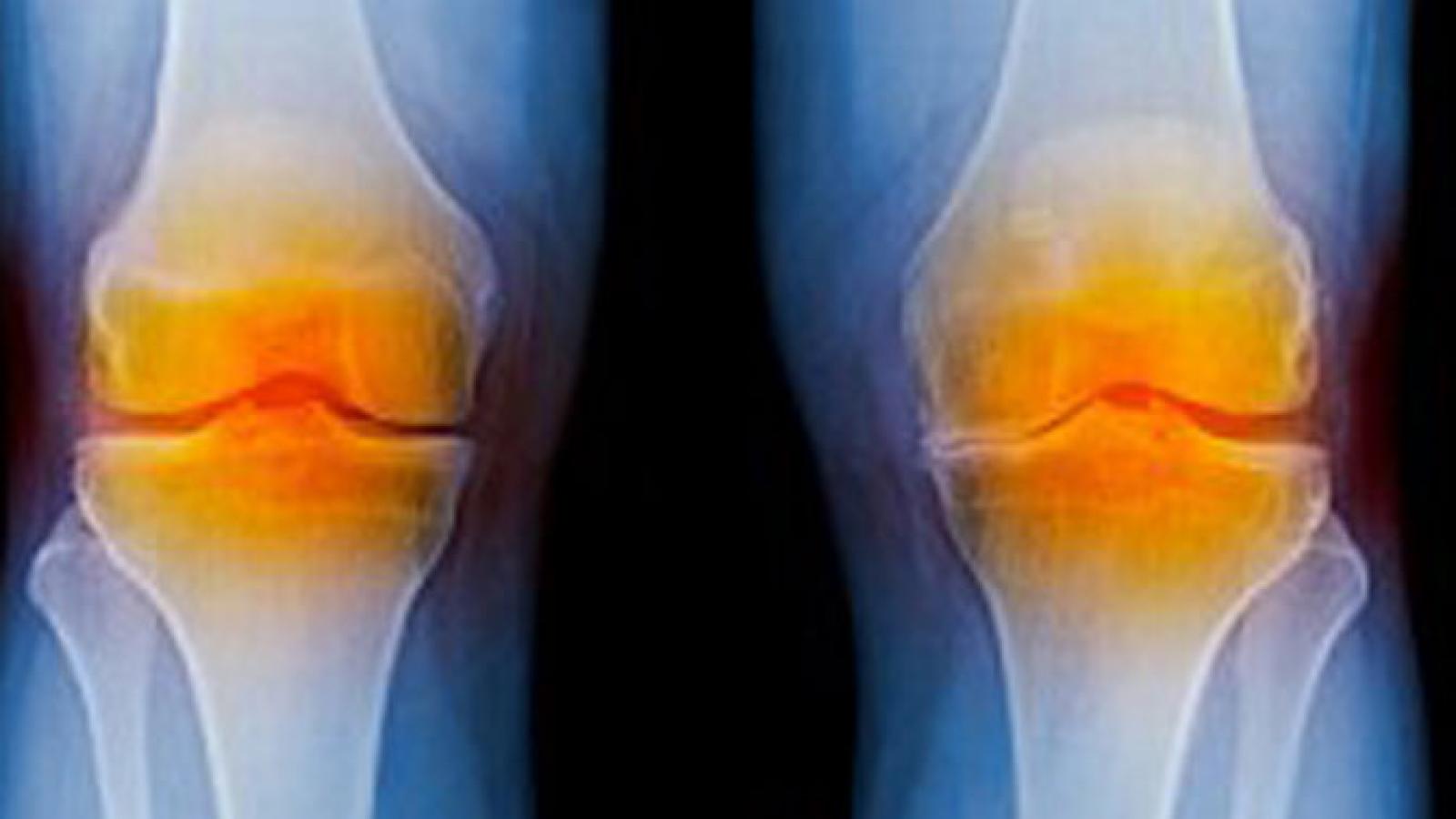 5-knee-replacement-facts.jpg