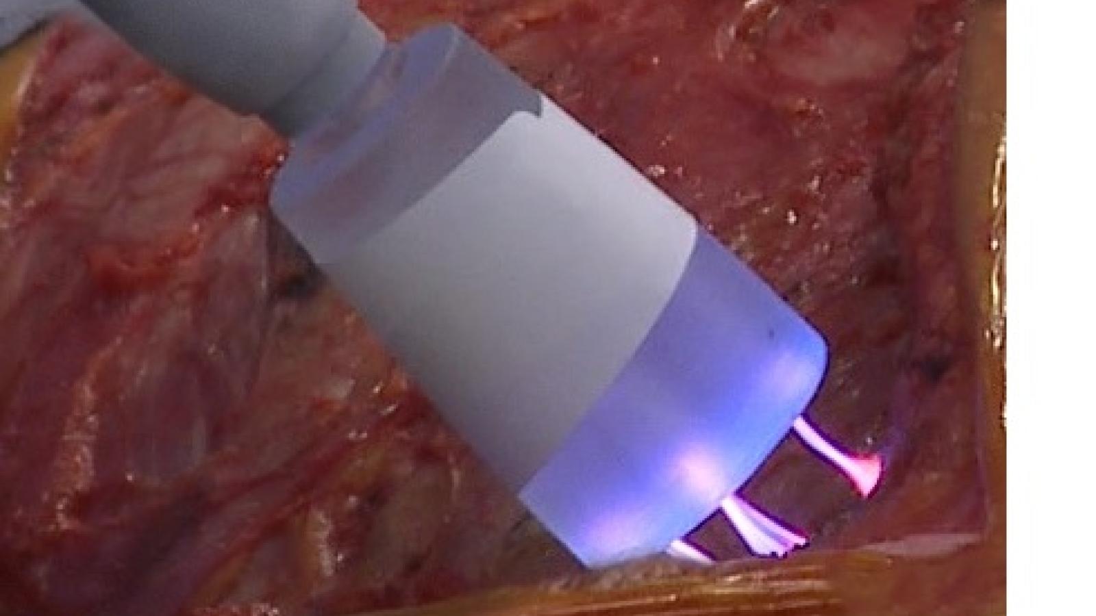 a beam of energized plasma kills cancer cells