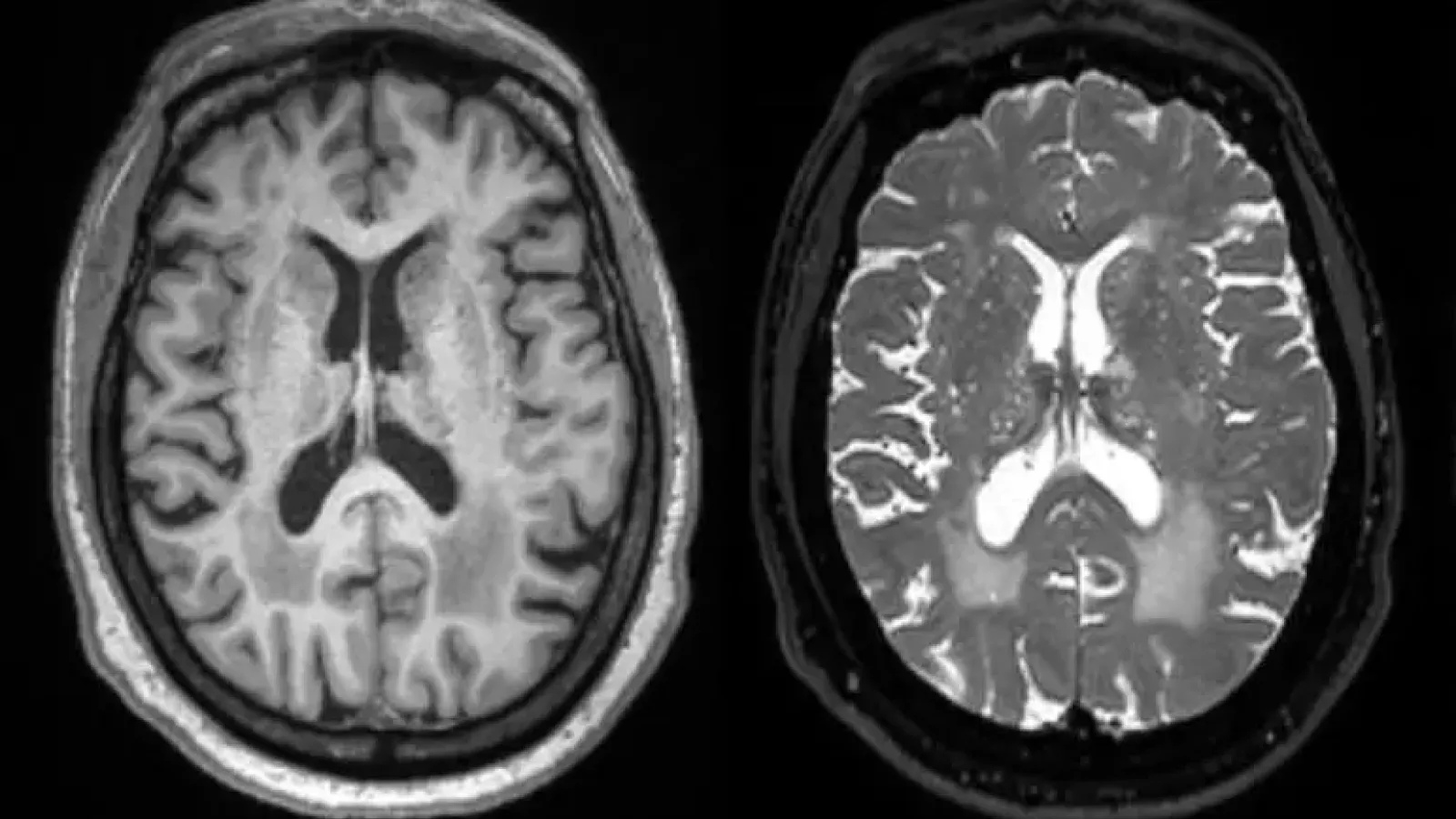 ARTS: neuroimaging measure of cerebral arteriosclerosis