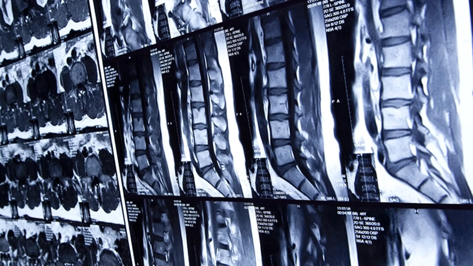 X-rays of lumbar spines