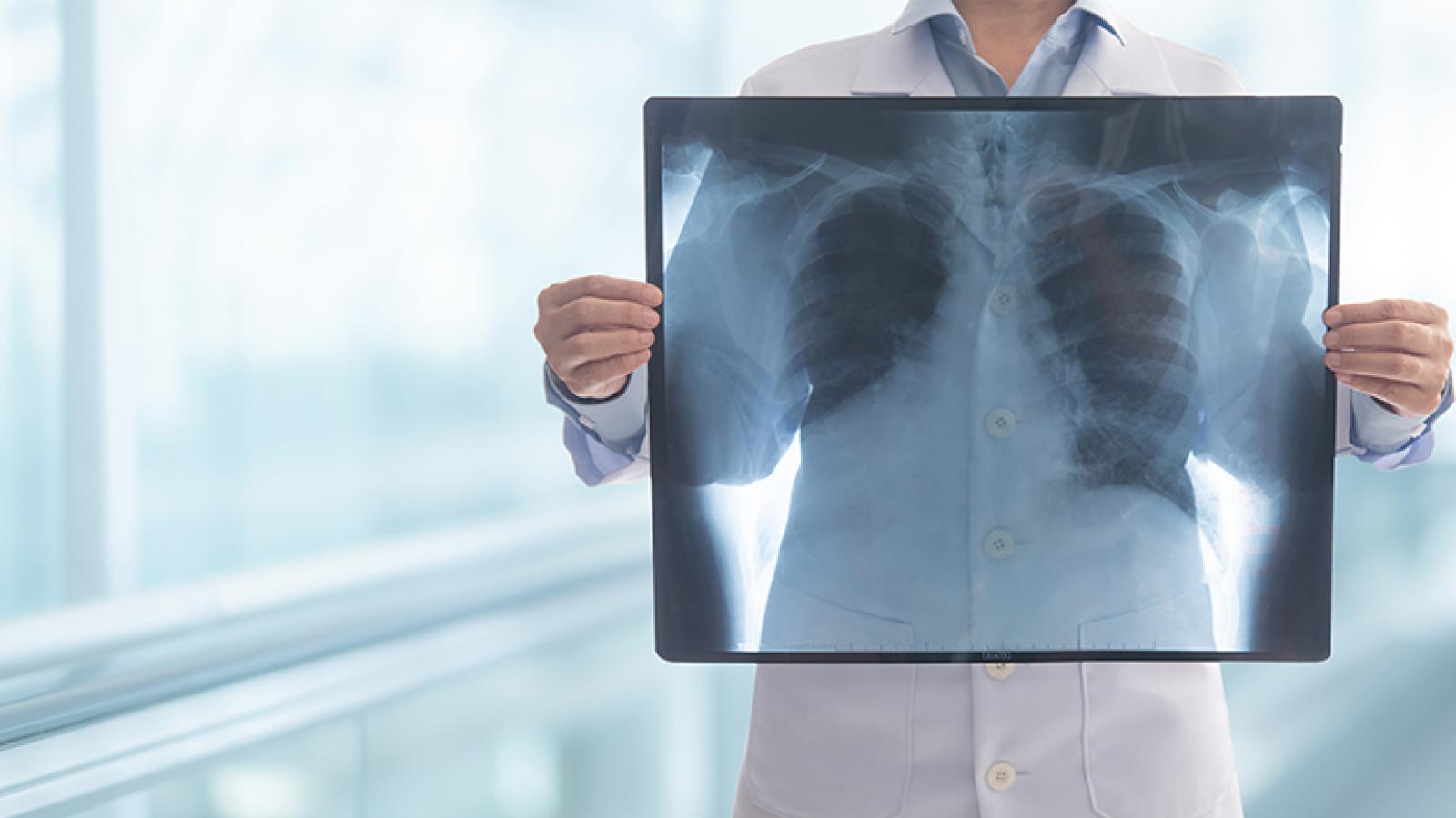 X-ray image of lungs