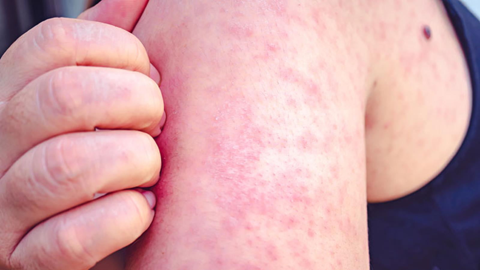 Woman with measles scratching arm