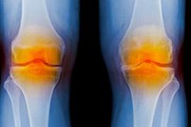 5-knee-replacement-facts.jpg